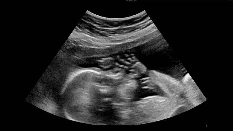 المرأة الحامل.. وحكم الصّيام