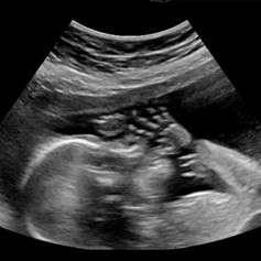 المرأة الحامل.. وحكم الصّيام